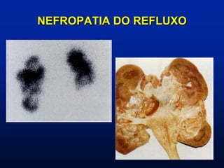 NEFROPATIA DO REFLUXO
 