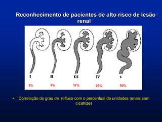 • Correlação do grau de refluxo com o percentual de unidades renais com
cicatrizes
Reconhecimento de pacientes de alto risco de lesão
renal
 