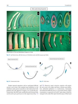 100
Simple intraoral operations with no anticipated difficult
airways can be done with standard nasal intubation or oral
intubation under general anaesthesia with endotracheal tube
pushed to the side opposite of surgery. Use of specially pre-
formed tubes like RAE tubes and Reinforced/Armoured tube
can be used to give good access to the surgical area (Figs. 7.4
and 7.5). However, major corrective surgeries will require
the oral cavity to be empty and hence warrant nasal intuba-
tion, submental intubation or a tracheostomy. Anticipated
non-­
obstructed difficult airway as assessed by history and/or
examination or suspected (cervical) C-spine injury should be
managed with awake fibre optic bronchoscopy or blind nasal
a c
d
b
Other useful Airway Equipment
©Association of Oral and Maxillofacial Surgeons of India
Fig. 7.3 (a) Nasal airway, (b) Oral airway, (c) Ventilation mask and (d) Laryngoscope blades
Regular Endotracheal Tube
Reinforced Endotracheal Tube
Fig. 7.4  Endotracheal tubes
Special Endotracheal Tubes-RAE tubes
a b
Fig. 7.5  RAE tubes
R. Jacob et al.
 