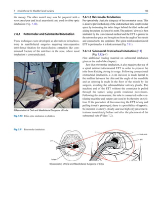 103
the airway. The other nostril may now be prepared with a
vasoconstrictor and local anaesthetic and used for fibre optic
intubation (Fig. 7.10).
7.6.1	 
Retromolar and Submental Intubation
These techniques were developed as alternatives to tracheos-
tomy in maxillofacial surgeries requiring intra-operative
inter-dental fixation for malocclusion correction like com-
minuted fracture of the mid-face or the nose, where nasal
intubation is contraindicated.
7.6.1.1	 Retromolar Intubation
Pre-operatively check the adequacy of the retromolar space.This
is done to prevent kinking of the endotracheal tube in retromolar
space by insinuating the index finger behind the third molar and
asking the patient to clench his teeth.The patients’ airway is then
intubated by the conventional method and the ETT is pushed in
the retromolar space and brought out from the angle of the mouth
and connected to the ventilator. The spiral reinforced/armoured
ETT is preferred as it is kink resistant (Fig. 7.11).
7.6.1.2	 
Submental Orotracheal Intubation: [13]
(Fig. 7.12a–f)
(See additional reading material on submental intubation
given at the end of the chapter).
Just like retromolar intubation, it also requires the use of
a spiral reinforced/armoured ETT in order to prevent the
tube from kinking during its usage. Following conventional
orotracheal intubation, a 2-cm incision is made lateral to
the midline between the chin and the angle of the mandible
and an opening is made in the floor of the mouth by the
surgeon, avoiding the submandibular salivary glands. The
machine end of the ETT without the connector is pulled
through the tunnel, using gentle rotational movements.
Following this manoeuvre, the tube is connected to the ven-
tilating machine and sutures are used to fix the tube in posi-
tion. If the procedure of disconnecting the ETT is long and
pulling it out is prolonged, there is a possibility of hypoxia.
So monitor oximetry closely and use high oxygen concen-
trations immediately before and after the placement of the
submental tube (Video 7.2).
©Association of Oral and Maxillofacial Surgeons of India
Fig. 7.10  Fibre optic intubation in children
©Association of Oral and Maxillofacial Surgeons of India
Fig. 7.11  Retromolar intubation
7  Anaesthesia for Maxillo Facial Surgery
 
