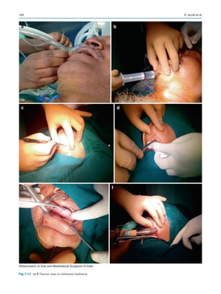 104
a
c d
b
e f
©Association of Oral and Maxillofacial Surgeons of India
Fig. 7.12 (a–f) Various steps in submental intubation
R. Jacob et al.
 
