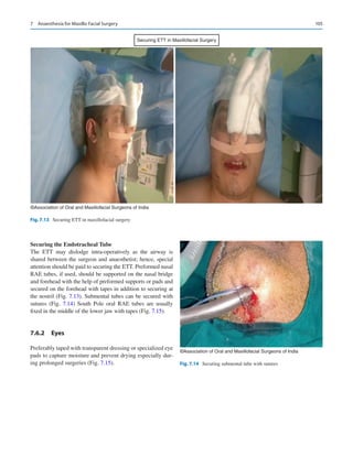 105
Securing ETT in Maxillofacial Surgery
©Association of Oral and Maxillofacial Surgeons of India
Fig. 7.13  Securing ETT in maxillofacial surgery
Securing the Endotracheal Tube
The ETT may dislodge intra-operatively as the airway is
shared between the surgeon and anaesthetist; hence, special
attention should be paid to securing the ETT. Preformed nasal
RAE tubes, if used, should be supported on the nasal bridge
and forehead with the help of preformed supports or pads and
secured on the forehead with tapes in addition to securing at
the nostril (Fig. 7.13). Submental tubes can be secured with
sutures (Fig.  7.14) South Pole oral RAE tubes are usually
fixed in the middle of the lower jaw with tapes (Fig. 7.15).
7.6.2	 Eyes
Preferably taped with transparent dressing or specialized eye
pads to capture moisture and prevent drying especially dur-
ing prolonged surgeries (Fig. 7.15).
©Association of Oral and Maxillofacial Surgeons of India
Fig. 7.14  Securing submental tube with sutures
7  Anaesthesia for Maxillo Facial Surgery
 
