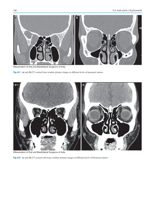128
a b
©Association of Oral and Maxillofacial Surgeons of India
Fig. 8.5 (a) and (b).CT coronal bone window primary images at different levels of paranasal sinuses
a b
©Association of Oral and Maxillofacial Surgeons of India
Fig. 8.6 (a) and (b).CT coronal soft-tissue window primary images at different levels of Paranasal sinuses
S. K. Joshi and A. I. Kochuveettil
 
