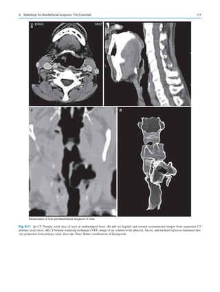 131
a
c d
b
©Association of Oral and Maxillofacial Surgeons of India
Fig. 8.11 (a) CT Primary axial slice of neck at midlaryngeal level. (b) and (c) Sagittal and coronal reconstructed images from sequential CT
primary axial slices. (d) CT Volume rendering technique (VRT) image of air column in the pharynx, larynx, and tracheal region as minimum den-
sity projection from primary axial slices (a). Note: Better visualization of laryngocele
8  Radiology for Maxillofacial Surgeons: The Essentials
 