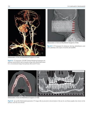 132
©Association of Oral and Maxillofacial Surgeons of India
Fig. 8.12  CT angiogram: 3D VRT (Volume Rendering Technique) dis-
playing carotid arteries and its branches along with carotid body tumor.
It is a reconstructed image from primary thin axial CT slices
©Association of Oral and Maxillofacial Surgeons of India
Fig. 8.13  CT Scanogram for dentascan showing submillimeter axial
slices planning in the region of maxilla and mandible
a b
©Association of Oral and Maxillofacial Surgeons of India
Fig. 8.14 (a) and (b) .Reformatted panoramic CT images (b) are procured at desired plane of the jaw by curvilinear graphic lines drawn on the
primary axial slice (a) selected
S. K. Joshi and A. I. Kochuveettil
 