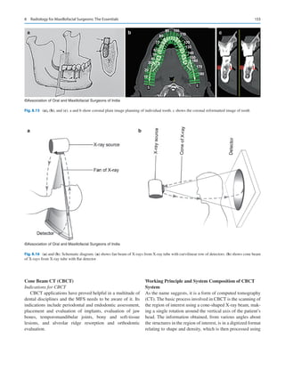 133
Cone Beam CT (CBCT)
Indications for CBCT
CBCT applications have proved helpful in a multitude of
dental disciplines and the MFS needs to be aware of it. Its
indications include periodontal and endodontic assessment,
placement and evaluation of implants, evaluation of jaw
bones, temporomandibular joints, bony and soft-tissue
lesions, and alveolar ridge resorption and orthodontic
evaluation.
Working Principle and System Composition of CBCT
System
As the name suggests, it is a form of computed tomography
(CT). The basic process involved in CBCT is the scanning of
the region of interest using a cone-shaped X-ray beam, mak-
ing a single rotation around the vertical axis of the patient’s
head. The information obtained, from various angles about
the structures in the region of interest, is in a digitized format
relating to shape and density, which is then processed using
a b c
©Association of Oral and Maxillofacial Surgeons of India
Fig. 8.15 (a), (b), and (c). a and b show coronal plain image planning of individual tooth. c shows the coronal reformatted image of tooth
a b
©Association of Oral and Maxillofacial Surgeons of India
Fig. 8.16 (a) and (b). Schematic diagram. (a) shows fan beam of X-rays from X-ray tube with curvilinear row of detectors. (b) shows cone beam
of X-rays from X-ray tube with flat detector
8  Radiology for Maxillofacial Surgeons: The Essentials
 