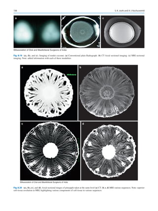 138
a b c
©Association of Oral and Maxillofacial Surgeons of India
Fig. 8.19 (a), (b), and (c). Imaging of tender coconut. (a) Conventional plain Radiograph. (b) CT Axial sectional imaging. (c) MRI sectional
imaging. Note: added information with each of these modalities
a
c d
b
©Association of Oral and Maxillofacial Surgeons of India
Fig. 8.20 (a), (b), (c), and (d). Axial sectional images of pineapple taken at the same level (a) CT. (b, c, d) MRI various sequences. Note: superior
soft-­
tissue resolution in MRI, highlighting various components of soft tissue in various sequences
S. K. Joshi and A. I. Kochuveettil
 