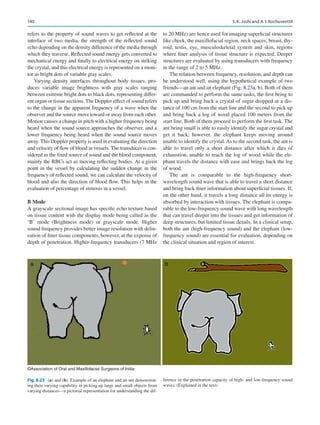 140
refers to the property of sound waves to get reflected at the
interface of two media, the strength of the reflected sound
echo depending on the density difference of the media through
which they traverse. Reflected sound energy gets converted to
mechanical energy and finally to electrical energy on striking
the crystal, and this electrical energy is represented on a moni-
tor as bright dots of variable gray scales.
Varying density interfaces throughout body tissues, pro-
duces variable image brightness with gray scales ranging
between extreme bright dots to black dots, representing differ-
ent organ or tissue sections. The Doppler effect of sound refers
to the change in the apparent frequency of a wave when the
observer and the source move toward or away from each other.
Motion causes a change in pitch with a higher frequency being
heard when the sound source approaches the observer, and a
lower frequency being heard when the sound source moves
away. This Doppler property is used in evaluating the direction
and velocity of flow of blood in vessels. The transducer is con-
sidered as the fixed source of sound and the blood component,
mainly the RBCs act as moving reflecting bodies. At a given
point in the vessel by calculating the sudden change in the
frequency of reflected sound, we can calculate the velocity of
blood and also the direction of blood flow. This helps in the
evaluation of percentage of stenosis in a vessel.
B Mode
A grayscale sectional image has specific echo texture based
on tissue content with the display mode being called as the
‘B’ mode (Brightness mode) or grayscale mode. Higher
sound frequency provides better image resolution with delin-
eation of finer tissue components, however, at the expense of
depth of penetration. Higher-frequency transducers (7 MHz
to 20 MHz) are hence used for imaging superficial structures
like cheek, the maxillofacial region, neck spaces, breast, thy-
roid, testis, eye, musculoskeletal system and skin, regions
where finer analysis of tissue structure is expected. Deeper
structures are evaluated by using transducers with frequency
in the range of 2 to 5 MHz.
The relation between frequency, resolution, and depth can
be understood well, using the hypothetical example of two
friends—an ant and an elephant (Fig. 8.23a, b). Both of them
are commanded to perform the same tasks, the first being to
pick up and bring back a crystal of sugar dropped at a dis-
tance of 100 cm from the start line and the second to pick up
and bring back a log of wood placed 100 meters from the
start line. Both of them proceed to perform the first task. The
ant being small is able to easily identify the sugar crystal and
get it back; however, the elephant keeps moving around
unable to identify the crystal. As to the second task, the ant is
able to travel only a short distance after which it dies of
exhaustion, unable to reach the log of wood while the ele-
phant travels the distance with ease and brings back the log
of wood.
The ant is comparable to the high-frequency short-­
wavelength sound wave that is able to travel a short distance
and bring back finer information about superficial tissues. If,
on the other hand, it travels a long distance all its energy is
absorbed by interaction with tissues. The elephant is compa-
rable to the low-frequency sound wave with long wavelength
that can travel deeper into the tissues and get information of
deep structures, but limited tissue details. In a clinical setup,
both the ant (high-frequency sound) and the elephant (low-­
frequency sound) are essential for evaluation, depending on
the clinical situation and region of interest.
Fig. 8.23 (a) and (b). Example of an elephant and an ant demonstrat-
ing their varying capability in picking up large and small objects from
varying distances—a pictorial representation for understanding the dif-
ference in the penetration capacity of high- and low-frequency sound
waves. (Explained in the text)
a b
©Association of Oral and Maxillofacial Surgeons of India
S. K. Joshi and A. I. Kochuveettil
 