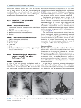 143
mary scan is complete, specific areas called the lawyer’s
zone or hidden areas of the lung need to be looked over a
second time. These areas include both the hilar regions, both
cardiophrenic regions, both apical and clavicular regions,
and finally also through the heart and diaphragms.
8.10.3	 
Requesting a Chest Radiograph:
Clinical indications
8.10.3.1	 Preoperative evaluation
	 i.	Cleft lip and palate/any other congenital maxillofacial
anomaly
	ii.	 Infections of the maxillofacial region
	
iii.	 Known malignancy in maxillofacial region
	iv.	 Trauma.
8.10.3.2	 
Intra- / Postoperative recovery room
	 i.	 Sudden choking and breathlessness
	ii.	 Sudden cyanosis
	iii.	 Sudden cough
	iv.	 Chest pain.
	v.	Fever
	vi.	 Evaluation of chest tubes and catheters (suggested refer-
ence for further reading).
8.10.4	 
“The Chest Radiograph. A Mysterious
Treasure”…the More you Search,
the More you Find!!
8.10.4.1	 Consolidation
It is one of the most common terminologies used in
Radiology. Clinicians and pathology textbooks, however,
commonly use the term pneumonia. Any infection of the
lung parenchyma is broadly referred to as pneumonia.
Involvement of the alveolar components of the lung paren-
chyma by the infection is called parenchymal consolidation
[10]. It is a disease process in which the air normally present
within the small lung air sacs (alveoli) is replaced by liquids
like pus, blood, or other fluids, or solids like tumor cells.
Radiologically, consolidation appears opaque [11].
Normally, the alveoli are filled with air and so the normal
opaque pulmonary vasculature can be visualized against the
dark background of air. However, as discussed earlier, the
replacement of the air spaces by any form of fluid or solid
material makes the normally visualized pulmonary vessels
inapparent with the air containing bronchi being visualized
against the opaque background, which is called the air bron-
chogram (Fig. 8.25a–c).
The consolidation process involving a single lobe and
limited by a fissure is called as lobar pneumonia, while the
involvement of the entire lung is known as whole-lung con-
solidation. At times, the process is not as uniform and is dis-
tributed in the form of patchy opacities with intervening
nonopacified alveoli, an appearance referred to as the air
alveologram, which is seen in Bronchopneumonia.
Pulmonary Edema
Maxillofacial surgeons are often faced with the problem of
patients going into a state of sudden breathlessness in the
postoperative recovery room for which the MFS asks for a
portable chest radiograph. One of the most common causes
of sudden breathlessness in the postoperative recovery room
is pulmonary edema. The common confusion for which MFS
postgraduates seek the radiologist’s opinion is whether the
cause of breathlessness is bronchopneumonia or aspiration
bronchopneumonia.
In case of acute cardiogenic pulmonary edema caused
either due to left ventricular failure or fluid overload, the
characteristic radiographic abnormality would reveal bilat-
eral symmetrical areas of consolidation predominantly in the
a b c
©Association of Oral and Maxillofacial Surgeons of India
Fig. 8.25 (a) and (b) Consolidation: Homogeneous opacities with “Air-bronchogram” sign. (c) Schematic diagram showing group of alveoli filled
with fluid replacing normal air
8  Radiology for Maxillofacial Surgeons: The Essentials
 
