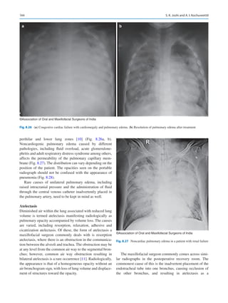 144
perihilar and lower lung zones [10] (Fig.  8.26a, b).
Noncardiogenic pulmonary edema caused by different
pathologies, including fluid overload, acute glomerulone-
phritis and adult respiratory distress syndrome among others,
affects the permeability of the pulmonary capillary mem-
brane (Fig. 8.27). The distribution can vary depending on the
position of the patient. The opacities seen on the portable
radiograph should not be confused with the appearance of
pneumonia (Fig. 8.28).
Rare causes of unilateral pulmonary edema, including
raised intracranial pressure and the administration of fluid
through the central venous catheter inadvertently placed in
the pulmonary artery, need to be kept in mind as well.
Atelectasis
Diminished air within the lung associated with reduced lung
volume is termed atelectasis manifesting radiologically as
pulmonary opacity accompanied by volume loss. The causes
are varied, including resorption, relaxation, adhesive and
cicatrization atelectasis. Of these, the form of atelectasis a
maxillofacial surgeon commonly deals with is resorption
atelectasis, where there is an obstruction in the communica-
tion between the alveoli and trachea. The obstruction may be
at any level from the common air way to the segmental bron-
chus; however, common air way obstruction resulting in
bilateral atelectasis is a rare occurrence [11]. Radiologically,
the appearance is that of a homogeneous opacity without an
air bronchogram sign, with loss of lung volume and displace-
ment of structures toward the opacity.
The maxillofacial surgeon commonly comes across simi-
lar radiographs in the postoperative recovery room. The
commonest cause of this is the inadvertent placement of the
endotracheal tube into one bronchus, causing occlusion of
the other bronchus, and resulting in atelectasis as a
a b
©Association of Oral and Maxillofacial Surgeons of India
Fig. 8.26 (a) Congestive cardiac failure with cardiomegaly and pulmonary edema. (b) Resolution of pulmonary edema after treatment
©Association of Oral and Maxillofacial Surgeons of India
Fig. 8.27  Noncardiac pulmonary edema in a patient with renal failure
S. K. Joshi and A. I. Kochuveettil
 