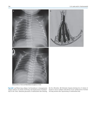 146
a
c
b
©Association of Oral and Maxillofacial Surgeons of India
Fig. 8.29 (a) Whole lung collapse: Left hemithorax is homogenously
opaque with loss of volume of left lung with displacement of mediasti-
num to left. Note: Abnormal placement of endotracheal tube blocking
the (Lt.) Bronchus. (b) Schematic diagram showing loss of volume of
alveoli as seen in collapse with absence of air. (c) Reversion of normal
left lung aeration after repositioning of endotracheal tube
S. K. Joshi and A. I. Kochuveettil
 