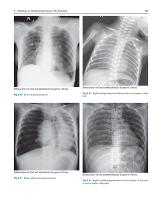 147
©Association of Oral and Maxillofacial Surgeons of India
Fig. 8.30  Left-sided pneumothorax
©Association of Oral and Maxillofacial Surgeons of India
Fig. 8.32  Right-sided pseudopneumothorax due to air trapped in skin
fold
©Association of Oral and Maxillofacial Surgeons of India
Fig. 8.31  Right-sided tension pneumothorax
©Association of Oral and Maxillofacial Surgeons of India
Fig. 8.33  Right-sided hemopneumothorax with multiple rib fractures
as seen in supine radiograph
8  Radiology for Maxillofacial Surgeons: The Essentials
 