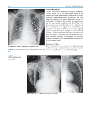 148
Surgical Emphysema
Though subcutaneous emphysema or surgical emphysema
actually means gas in the subcutaneous tissues, it also
includes soft-tissue emphysema that dissects into the deeper
soft tissues and musculature along fascial planes. The trans-
lucent air spreads over the chest wall and axilla into the root
of the neck. Fascial planes clearly outline the pectoralis mus-
cle and neurovascular bundles in neck (Fig.  8.35a, b). If
trauma is the cause, the gas by itself may not need treatment,
but its identification is of importance as it may be the only
indication of the presence of other serious injuries requiring
urgent management. Surgical emphysema can uncommonly
occur as a serious complication of oral and maxillofacial sur-
gical procedures. It may also occur following teeth extrac-
tion, endodontic treatment, or procedures like restorative
dentistry, periodontal and temporomandibular joint surgery,
or facial fracture repair.
Pulmonary Nodules
For all intents and purposes, a nodule seen in the lung (espe-
cially in the lower zones) should be considered as metastasis
unless proven otherwise, by a maxillofacial surgeon.
©Association of Oral and Maxillofacial Surgeons of India
Fig. 8.34  Pneumomediastinum. Air around the pulmonary artery and
heart.
a b
©Association of Oral and Maxillofacial Surgeons of India
Fig. 8.35 (a) and (b).
Surgical emphysema with
pneumothorax
S. K. Joshi and A. I. Kochuveettil
 