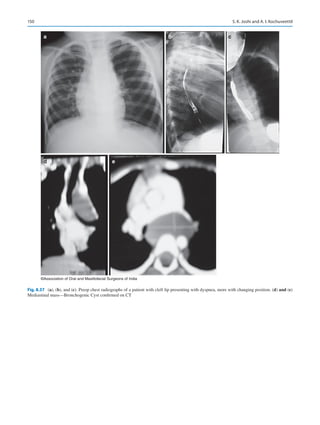 150
a
d e
b c
©Association of Oral and Maxillofacial Surgeons of India
Fig. 8.37 (a), (b), and (c). Preop chest radiographs of a patient with cleft lip presenting with dyspnea, more with changing position. (d) and (e)
Mediastinal mass—Bronchogenic Cyst confirmed on CT
S. K. Joshi and A. I. Kochuveettil
 