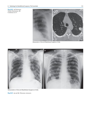 151
a b
©Association of Oral and Maxillofacial Surgeons of India
Fig. 8.38 (a) Pulmonary
Nodule-Hamartoma. (b)
Confirmed on CT
a b
©Association of Oral and Maxillofacial Surgeons of India
Fig. 8.39 (a) and (b). Pulmonary metastasis
8  Radiology for Maxillofacial Surgeons: The Essentials
 
