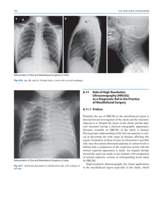 152
8.11	 
Role of High Resolution
Ultrasonography (HRUSG)
as a Diagnostic Aid in the Practice
of Maxillofacial Surgery
8.11.1	 Preface
Primarily the use of HRUSG in the maxillofacial region is
directed toward investigation of the cheek and the structures
adjacent to it. Despite the layers of the cheek and the adja-
cent structures having a classical sonographic appearance,
literature available on HRUSG of the cheek is limited.
Having proper understanding of the relevant anatomy is criti-
cal in discerning the wide range of diseases affecting this
region. Evaluation of these lesions by ultrasound is possible
only once the normal ultrasound anatomy at various levels is
defined and a comparison of the suspicious lesion with the
normal expected appearance is made. An original attempt
toward this goal was made at our institute with comparison
of normal cadaveric sections at corresponding levels taken
by HRUSG.
High-resolution ultrasonography has broad applications
in the maxillofacial region especially in the cheek, which
a b c
©Association of Oral and Maxillofacial Surgeons of India
Fig. 8.40 (a), (b), and (c). Foreign body, a coin in the cervical esophagus
©Association of Oral and Maxillofacial Surgeons of India
Fig. 8.41  Abnormal placement of endotracheal tube with collapse of
left lobe
S. K. Joshi and A. I. Kochuveettil
 