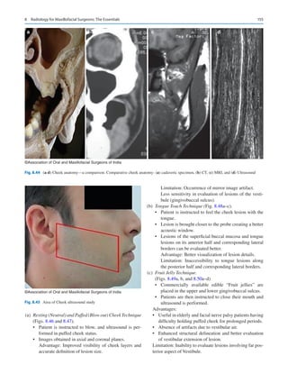 155
	(a)	 Resting (Neutral) and Puffed (Blow out) CheekTechnique
(Figs. 8.46 and 8.47).
•	 Patient is instructed to blow, and ultrasound is per-
formed in puffed cheek status.
•	 Images obtained in axial and coronal planes.
Advantage: Improved visibility of cheek layers and
accurate definition of lesion size.
Limitation: Occurrence of mirror image artifact.
Less sensitivity in evaluation of lesions of the vesti-
bule (gingivobuccal sulcus).
	(b)	 Tongue Touch Technique (Fig. 8.48a–c).
•	 Patient is instructed to feel the cheek lesion with the
tongue.
•	 Lesion is brought closer to the probe creating a better
acoustic window.
•	 Lesions of the superficial buccal mucosa and tongue
lesions on its anterior half and corresponding lateral
borders can be evaluated better.
Advantage: Better visualization of lesion details.
Limitation: Inaccessibility to tongue lesions along
the posterior half and corresponding lateral borders.
	(c)	 Fruit Jelly Technique.
(Figs. 8.49a, b, and 8.50a–d)
•	 Commercially available edible “Fruit jellies” are
placed in the upper and lower gingivobuccal sulcus.
•	 Patients are then instructed to close their mouth and
ultrasound is performed.
Advantages:
•	 Useful in elderly and facial nerve palsy patients having
difficulty holding puffed cheek for prolonged periods.
•	 Absence of artifacts due to vestibular air.
•	 Enhanced structural delineation and better evaluation
of vestibular extension of lesion.
Limitation: Inability to evaluate lesions involving far pos-
terior aspect of Vestibule.
©Association of Oral and Maxillofacial Surgeons of India
a b c d
Fig. 8.44 (a-d) Cheek anatomy—a comparison. Comparative cheek anatomy- (a) cadaveric specimen, (b) CT, (c) MRI, and (d) Ultrasound
©Association of Oral and Maxillofacial Surgeons of India
Fig. 8.45  Area of Cheek ultrasound study
8  Radiology for Maxillofacial Surgeons: The Essentials
 