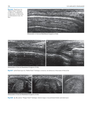 156
©Association of Oral and Maxillofacial Surgeons of India
Fig. 8.46  Cheek layers by
“Puffed Cheek” Technique.
(1) Mucosa. (2) Submucosa.
(3) Buccinator. (4) Buccal fat.
(5) Subcutaneous tissue. (6)
Skin
©Association of Oral and Maxillofacial Surgeons of India
a b
Fig. 8.47 (a, b) Cheek layers by “Puffed Cheek” Technique. m-mucosa, sm-submucosa, b-buccinator, bf-buccal fat
a b c
©Association of Oral and Maxillofacial Surgeons of India
Fig. 8.48 (a), (b), and (c). “Tongue Touch” Technique. Anterior tongue, its tip and lateral borders and cheek layers
S. K. Joshi and A. I. Kochuveettil
 