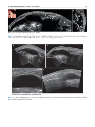 157
a b
©Association of Oral and Maxillofacial Surgeons of India
Fig. 8.49 (a)Axial panoramic (b) Coronal Cheek layers by “Fruit Jelly” Technique. (1) Jelly (2)Angle of mouth (3)Alveolar process (4) Masseter
(5) Mandible (6) Parotid (7) Maxilla (8) Mandible (Asterisk)- Upper and lower gingivobuccal sulcus
a
c d
b
©Association of Oral and Maxillofacial Surgeons of India
Fig. 8.50 (a, b, c, and d).Cheek layers by “Fruit jelly” Technique. Panoramic axial slices. Coronal slices showing superior and inferior vestibules
along with layers of cheek/alveolar surfaces
8  Radiology for Maxillofacial Surgeons: The Essentials
 