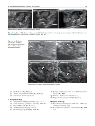 159
a b c
©Association of Oral and Maxillofacial Surgeons of India
Fig. 8.52 (a, b and c). Cheek abscess. Focal organized thick echogenic collection in the deep subcutaneous plane with minimal extension into
buccinator muscle (45 year old male, with habit of chewing betel nut)
a
c
b
d
©Association of Oral and Maxillofacial Surgeons of India
Fig. 8.53 (a–d) Chronic
osteomyelitis mandible.
HRUSG showing hyperechoic
lesion with hypoechoic
halofungal granuloma
	(b)	
Cheek abscess (Fig. 8.52a–c).
	(c)	
Chronic osteomyelitis mandible (Fig. 8.53a, b).
	(d)	
Cysticercosis parotid (Fig. 8.54).
	2.	 Benign Pathology.
	(a)	
Oral submucosal fibrosis (OSMF) (Fig. 8.55a–c).
	(b)	
Lesion at opening of Stenson’s Duct (Fig. 8.56a, b).
	(c)	
Intraoral Mucocele (Fig. 8.57a, b).
	(d)	
Cheek lymphangioma (Fig. 8.58a–d).
	(e)	
Epidermoid cyst of cheek (Fig. 8.59a, b).
	(f)	
Painless unilateral swollen cheek (Intramasseteric
lipoma) (Fig. 8.60).
	(g)	
Stenson’s Duct calculus (Fig. 8.61a, b).
	(h)	
Polycystic disease of parotid (Fig. 8.62a, b).
	3.	 Malignant Pathology.
	(a)	
Buccal mucosal malignancy with intact submucosa
and buccinator (Fig. 8.63).
	(b)	
Buccal mucosal squamous cell carcinoma (Fig. 8.64
a-c).
8  Radiology for Maxillofacial Surgeons: The Essentials
 
