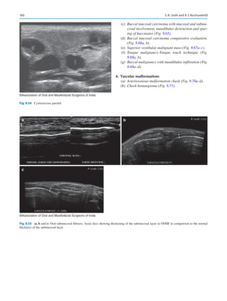 160
a
c
b
©Association of Oral and Maxillofacial Surgeons of India
Fig. 8.55 (a, b and c) Oral submucosal fibrosis. Axial slice showing thickening of the submucosal layer in OSMF in comparison to the normal
thickness of the submucosal layer
©Association of Oral and Maxillofacial Surgeons of India
Fig. 8.54  Cysticercosis parotid
	(c)	
Buccal mucosal carcinoma with mucosal and submu-
cosal involvement, mandibular destruction and spar-
ing of buccinator (Fig. 8.65).
	(d)	
Buccal mucosal carcinoma comparative evaluation.
(Fig. 8.66a, b).
	(e)	
Superior vestibular malignant mass (Fig. 8.67a–c).
	(f)	
Tongue malignancy-Tongue touch technique (Fig.
8.68a, b).
	(g)	
Buccal malignancy with mandibular infiltration (Fig.
8.69a–d).
	4.	 Vascular malformations
	(a)	
Arteriovenous malformation cheek (Fig. 8.70a–d).
	(b)	
Cheek hemangioma (Fig. 8.71).
S. K. Joshi and A. I. Kochuveettil
 