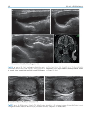 162
a
c d
b
©Association of Oral and Maxillofacial Surgeons of India
Fig. 8.58 (a, b, c, and d). Cheek lymphangioma. Fluid-filled cystic
lesion deep to submucosal layer with deep space extension adjacent to
the masseter medial to mandibular ramus MRI coronal T2W imaging
confirms hyperintense fluid along left side of cheek extending into
infratemporal fossa (25 year old male, presenting with soft, painless
swelling of left cheek)
a b
©Association of Oral and Maxillofacial Surgeons of India
Fig. 8.59 (a) and (b). Epidermoid cyst of cheek. Well-defined complex cystic lesion in the subcutaneous plane with internal echogenic contents
causing displacement of underlying cheek layers (28 year old male presenting with painless left cheek swelling)
S. K. Joshi and A. I. Kochuveettil
 