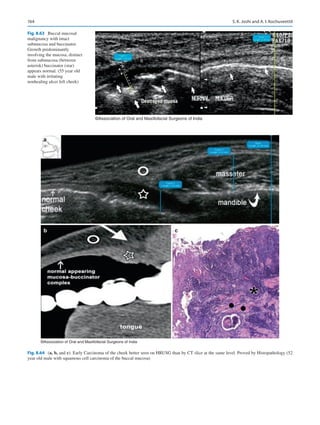 164
©Association of Oral and Maxillofacial Surgeons of India
Fig. 8.63  Buccal mucosal
malignancy with intact
submucosa and buccinator.
Growth predominantly
involving the mucosa, distinct
from submucosa (between
asterisk) buccinator (star)
appears normal. (55 year old
male with irritating
nonhealing ulcer left cheek)
a
b c
©Association of Oral and Maxillofacial Surgeons of India
Fig. 8.64 (a, b, and c). Early Carcinoma of the cheek better seen on HRUSG than by CT slice at the same level. Proved by Histopathology (52
year old male with squamous cell carcinoma of the buccal mucosa)
S. K. Joshi and A. I. Kochuveettil
 
