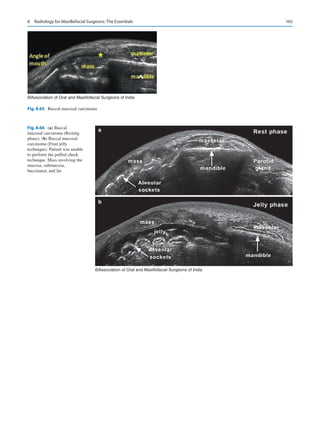 165
©Association of Oral and Maxillofacial Surgeons of India
Fig. 8.65  Buccal mucosal carcinoma
a
b
©Association of Oral and Maxillofacial Surgeons of India
Fig. 8.66 (a) Buccal
mucosal carcinoma (Resting
phase). (b) Buccal mucosal
carcinoma (Fruit jelly
technique). Patient was unable
to perform the puffed cheek
technique. Mass involving the
mucosa, submucosa,
buccinator, and fat
8  Radiology for Maxillofacial Surgeons: The Essentials
 