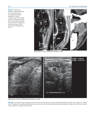 166
a b c
©Association of Oral and Maxillofacial Surgeons of India
Fig. 8.67 (a, b and c).
Superior vestibular malignant
mass. Coronal sections
revealing predominantly
hypoechoic, superior
vestibular mass with irregular
margins extending into cheek
layers and causing underlying
bony destruction. Comparison
between (a) neutral cheek,
(b) fruit jelly Technique and
(c) CT
a b
©Association of Oral and Maxillofacial Surgeons of India
Fig. 8.68 (a) and (b). Tongue malignancy against cheek wall. Irregular lesion along the Right anterolateral margin of the tongue by “Tongue
touch” technique. Few enlarged lymph nodes are also noted with loss of hilar anatomy representing metastatic lymph nodes. (40 year old male,
with complaint of swelling over the tongue)
S. K. Joshi and A. I. Kochuveettil
 