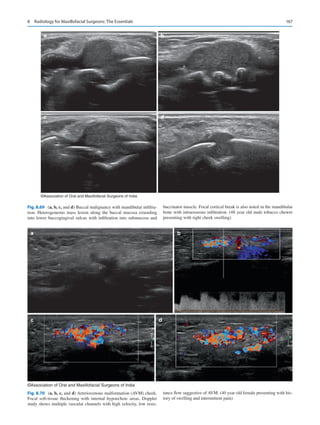 167
a b
c d
©Association of Oral and Maxillofacial Surgeons of India
Fig. 8.69 (a, b, c, and d) Buccal malignancy with mandibular infiltra-
tion. Heterogeneous mass lesion along the buccal mucosa extending
into lower buccogingival sulcus with infiltration into submucosa and
buccinator muscle. Focal cortical break is also noted in the mandibular
bone with intraosseous infiltration. (48 year old male tobacco chewer
presenting with right cheek swelling)
a
c d
b
©Association of Oral and Maxillofacial Surgeons of India
Fig. 8.70 (a, b, c, and d) Arteriovenous malformation (AVM) cheek.
Focal soft-tissue thickening with internal hypoechoic areas. Doppler
study shows multiple vascular channels with high velocity, low resis-
tance flow suggestive of AVM. (40 year old female presenting with his-
tory of swelling and intermittent pain)
8  Radiology for Maxillofacial Surgeons: The Essentials
 