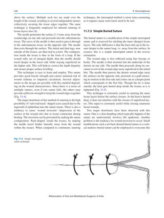 226
above the surface. Multiple such ties are made over the
length of the wound, resulting in several independent sutures
collectively securing the tissue edges together. The same
technique is frequently employed for internal suturing of
tissue layers also [4].
The needle penetrates the surface 2–3 mms away from the
wound edge on one side and proceeds into the subcutaneous
tissue. The curve of the needle is then used to pass it through
to the subcutaneous tissue on the opposite side. The needle
then exits through the surface. The initial and final tags, now
outside of the tissues, are then tied in a knot. The configura-
tion inside the tissue is thus in the form of a loop. If the
wound sides are of unequal depth, then the needle should
travel deeper in the lower side while staying superficial on
the higher side. This will help to correct the depth disparity
and ensure proper surface levelling.
This technique is easy to learn and employ. This suture
provides good tensile strength and carries minimal risk of
wound oedema or impaired circulation. Several adjust-
ments to the design are possible with this method depend-
ing on the wound characteristics. Since there is a series of
multiple sutures, even if one suture fails, the others may
provide sufficient strength to keep the wound edges together
(Fig. 11.4).
The major drawback of this method of suturing is the high
possibility of ‘rail-road track’ shaped scars caused due to the
ingrowth of epithelium into the suture tracks. There is also a
tendency to cause ‘wound inversion’ (depression of the
­
surface at the wound site) due to tissue contracture during
healing. The inversion can be prevented by making the suture
configuration ‘flask-shaped’ inside the tissues, by making
the needle travel farther laterally away from the wound
within the tissues. When compared to continuous suturing
techniques, the interrupted method is more time-consuming
as it requires many more knots need to be tied.
11.7.2  
Simple Buried Suture
The buried suture is a modification of the simple interrupted
suture and is reserved for stitching the inner (deeper) tissue
layers. The only difference is that the knot ends up in the tis-
sues deeper to the suture loop, i.e. away from the surface. In
essence, this is a simple interrupted suture in the reverse
orientation.
The wound edge is first reflected using fine forceps or
hooks. The needle is then inserted into the underside of the
dermis on one side. The needle then proceeds along its cur-
vature to exit in the wound edge more superficial to the initial
bite. The needle then pierces the dermis wound edge (near
the surface) on the opposite side, proceeds in a path mirror-
ing its motion in the first side and comes out at a deeper point
which corresponds to the first bite. Though the tie is done
outside, the knot gets buried deep inside the tissues as it is
tightened (Fig. 11.5).
This technique is extremely useful in suturing the inner
tissue layers before the surface closure. As the knot is buried
deep, it does not interfere with the closure of superficial lay-
ers. This aspect is extremely useful while closing cutaneous
facial wounds.
Two major drawbacks have been observed with this
suture. One is a skin dimpling which typically happens if the
suture arc inadvertently involves the epidermis. Another
problem is the tendency for wound inversion to occur. Small
modifications such a set-back dermal buried suture or a verti-
cal mattress buried suture can be employed to overcome this
©Association of Oral and Maxillofacial Surgeons of India
Fig. 11.4  Simple interrupted
suture technique
R. Veeraraghavan
 