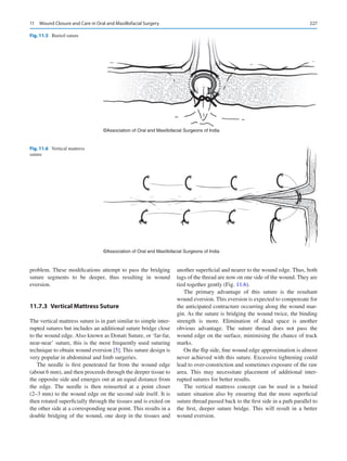 227
problem. These modifications attempt to pass the bridging
suture segments to be deeper, thus resulting in wound
eversion.
11.7.3  
Vertical Mattress Suture
The vertical mattress suture is in part similar to simple inter-
rupted sutures but includes an additional suture bridge close
to the wound edge. Also known as Donati Suture, or ‘far-far,
near-near’ suture, this is the most frequently used suturing
technique to obtain wound eversion [5]. This suture design is
very popular in abdominal and limb surgeries.
The needle is first penetrated far from the wound edge
(about 6 mm), and then proceeds through the deeper tissue to
the opposite side and emerges out at an equal distance from
the edge. The needle is then reinserted at a point closer
(2–3 mm) to the wound edge on the second side itself. It is
then rotated superficially through the tissues and is exited on
the other side at a corresponding near point. This results in a
double bridging of the wound, one deep in the tissues and
another superficial and nearer to the wound edge. Thus, both
tags of the thread are now on one side of the wound. They are
tied together gently (Fig. 11.6).
The primary advantage of this suture is the resultant
wound eversion. This eversion is expected to compensate for
the anticipated contracture occurring along the wound mar-
gin. As the suture is bridging the wound twice, the binding
strength is more. Elimination of dead space is another
­
obvious advantage. The suture thread does not pass the
wound edge on the surface, minimising the chance of track
marks.
On the flip side, fine wound edge approximation is almost
never achieved with this suture. Excessive tightening could
lead to over-constriction and sometimes exposure of the raw
area. This may necessitate placement of additional inter-
rupted sutures for better results.
The vertical mattress concept can be used in a buried
suture situation also by ensuring that the more superficial
suture thread passed back to the first side in a path parallel to
the first, deeper suture bridge. This will result in a better
wound eversion.
©Association of Oral and Maxillofacial Surgeons of India
Fig. 11.5  Buried suture
©Association of Oral and Maxillofacial Surgeons of India
Fig. 11.6  Vertical mattress
suture
11  Wound Closure and Care in Oral and Maxillofacial Surgery
 