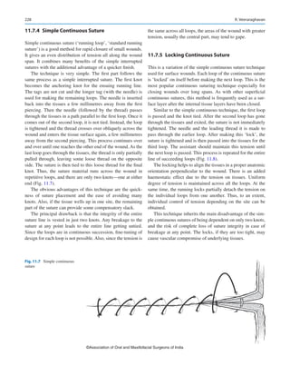 228
11.7.4  
Simple Continuous Suture
Simple continuous suture (‘running loop’, ‘standard running
suture’) is a good method for rapid closure of small wounds.
It gives an even distribution of tension all along the wound
span. It combines many benefits of the simple interrupted
sutures with the additional advantage of a quicker finish.
The technique is very simple. The first part follows the
same process as a simple interrupted suture. The first knot
becomes the anchoring knot for the ensuing running line.
The tags are not cut and the longer tag (with the needle) is
used for making the remaining loops. The needle is inserted
back into the tissues a few millimetres away from the first
piercing. Then the needle (followed by the thread) passes
through the tissues in a path parallel to the first loop. Once it
comes out of the second loop, it is not tied. Instead, the loop
is tightened and the thread crosses over obliquely across the
wound and enters the tissue surface again, a few millimetres
away from the second piercing. This process continues over
and over until one reaches the other end of the wound. As the
last loop goes through the tissues, the thread is only partially
pulled through, leaving some loose thread on the opposite
side. The suture is then tied to this loose thread for the final
knot. Thus, the suture material runs across the wound in
repetitive loops, and there are only two knots—one at either
end (Fig. 11.7).
The obvious advantages of this technique are the quick-
ness of suture placement and the ease of avoiding many
knots. Also, if the tissue wells up in one site, the remaining
part of the suture can provide some compensatory slack.
The principal drawback is that the integrity of the entire
suture line is vested in just two knots. Any breakage to the
suture at any point leads to the entire line getting untied.
Since the loops are in continuous succession, fine-tuning of
design for each loop is not possible. Also, since the tension is
the same across all loops, the areas of the wound with greater
tension, usually the central part, may tend to gape.
11.7.5  
Locking Continuous Suture
This is a variation of the simple continuous suture technique
used for surface wounds. Each loop of the continuous suture
is ‘locked’ on itself before making the next loop. This is the
most popular continuous suturing technique especially for
closing wounds over long spans. As with other superficial
continuous sutures, this method is frequently used as a sur-
face layer after the internal tissue layers have been closed.
Similar to the simple continuous technique, the first loop
is passed and the knot tied. After the second loop has gone
through the tissues and exited, the suture is not immediately
tightened. The needle and the leading thread it is made to
pass through the earlier loop. After making this ‘lock’, the
suture is tightened and is then passed into the tissues for the
third loop. The assistant should maintain this tension until
the next loop is passed. This process is repeated for the entire
line of succeeding loops (Fig. 11.8).
The locking helps to align the tissues in a proper anatomic
orientation perpendicular to the wound. There is an added
haemostatic effect due to the tension on tissues. Uniform
degree of tension is maintained across all the loops. At the
same time, the running locks partially detach the tension on
the individual loops from one another. Thus, to an extent,
individual control of tension depending on the site can be
obtained.
This technique inherits the main disadvantage of the sim-
ple continuous sutures of being dependent on only two knots,
and the risk of complete loss of suture integrity in case of
breakage at any point. The locks, if they are too tight, may
cause vascular compromise of underlying tissues.
©Association of Oral and Maxillofacial Surgeons of India
Fig. 11.7  Simple continuous
suture
R. Veeraraghavan
 