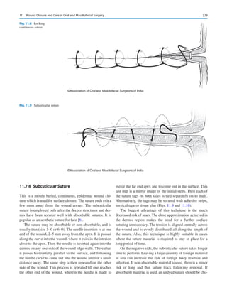 229
11.7.6  Subcuticular Suture
This is a mostly buried, continuous, epidermal wound clo-
sure which is used for surface closure. The suture ends exit a
few mms away from the wound corner. The subcuticular
suture is employed only after the deeper structures and der-
mis have been secured well with absorbable sutures. It is
popular as an aesthetic suture for face [6].
The suture may be absorbable or non-absorbable, and is
usually thin (size 5–0 or 6–0). The needle insertion is at one
end of the wound, 2–5 mm away from the apex. It is passed
along the curve into the wound, where it exits in the interior,
close to the apex. Then the needle is inserted again into the
dermis on any one side of the wound edge walls. Thereafter,
it passes horizontally parallel to the surface, and following
the needle curve to come out into the wound interior a small
distance away. The same step is then repeated on the other
side of the wound. This process is repeated till one reaches
the other end of the wound, wherein the needle is made to
pierce the far end apex and to come out in the surface. This
last step is a mirror image of the initial steps. Then each of
the suture tags on both sides is tied separately on to itself.
Alternatively, the tags may be secured with adhesive strips,
surgical tape or tissue glue (Figs. 11.9 and 11.10).
The biggest advantage of this technique is the much
decreased risk of scars. The close approximation achieved in
the dermis region makes the need for a further surface
­
suturing unnecessary. The tension is aligned centrally across
the wound and is evenly distributed all along the length of
the suture. Also, this technique is highly suitable in cases
where the suture material is required to stay in place for a
long period of time.
On the negative side, the subcuticular suture takes longer
time to perform. Leaving a large quantity of foreign material
in situ can increase the risk of foreign body reaction and
infection. If non-absorbable material is used, there is a minor
risk of long and thin suture track following removal. If
absorbable material is used, an undyed suture should be cho-
©Association of Oral and Maxillofacial Surgeons of India
Fig. 11.8 Locking
continuous suture
©Association of Oral and Maxillofacial Surgeons of India
Fig. 11.9  Subcuticular suture
11  Wound Closure and Care in Oral and Maxillofacial Surgery
 