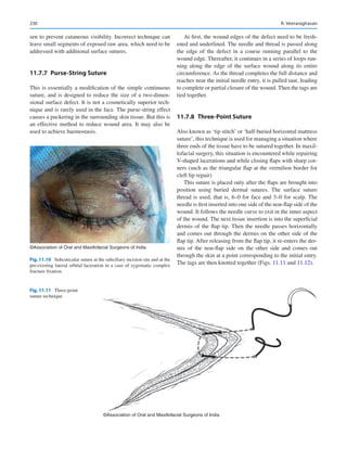 230
sen to prevent cutaneous visibility. Incorrect technique can
leave small segments of exposed raw area, which need to be
addressed with additional surface sutures.
11.7.7  Purse-String Suture
This is essentially a modification of the simple continuous
suture, and is designed to reduce the size of a two-dimen-
sional surface defect. It is not a cosmetically superior tech-
nique and is rarely used in the face. The purse-string effect
causes a puckering in the surrounding skin tissue. But this is
an effective method to reduce wound area. It may also be
used to achieve haemostasis.
At first, the wound edges of the defect need to be fresh-
ened and underlined. The needle and thread is passed along
the edge of the defect in a course running parallel to the
wound edge. Thereafter, it continues in a series of loops run-
ning along the edge of the surface wound along its entire
circumference. As the thread completes the full distance and
reaches near the initial needle entry, it is pulled taut, leading
to complete or partial closure of the wound. Then the tags are
tied together.
11.7.8  Three-Point Suture
Also known as ‘tip stitch’ or ‘half-buried horizontal mattress
suture’, this technique is used for managing a situation where
three ends of the tissue have to be sutured together. In maxil-
lofacial surgery, this situation is encountered while repairing
V-shaped lacerations and while closing flaps with sharp cor-
ners (such as the triangular flap at the vermilion border for
cleft lip repair)
This suture is placed only after the flaps are brought into
position using buried dermal sutures. The surface suture
thread is used, that is, 6–0 for face and 3–0 for scalp. The
needle is first inserted into one side of the non-flap side of the
wound. It follows the needle curve to exit in the inner aspect
of the wound. The next tissue insertion is into the superficial
dermis of the flap tip. Then the needle passes horizontally
and comes out through the dermis on the other side of the
flap tip. After releasing from the flap tip, it re-enters the der-
mis of the non-flap side on the other side and comes out
through the skin at a point corresponding to the initial entry.
The tags are then knotted together (Figs. 11.11 and 11.12).
©Association of Oral and Maxillofacial Surgeons of India
Fig. 11.10  Subcuticular suture at the subciliary incision site and at the
pre-existing lateral orbital laceration in a case of zygomatic complex
fracture fixation
©Association of Oral and Maxillofacial Surgeons of India
Fig. 11.11 Three-point
suture technique
R. Veeraraghavan
 