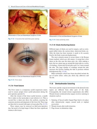 231
11.7.9  Frost Suture
The Frost suture is a temporary eyelid suspension suture,
used to ensure proper lower eyelid placement during the
post-operative period [7].
After the closure of the lower eyelid incision, a needle
bite is taken on the tarsal plate or just inferior to it. Then a
second bite is taken just above the eyebrow, ensuring the
anatomic position and alignment of the lower lid. These tags
are then tied or secured with tapes or tissue glue (Fig. 11.13).
These sutures may be removed on third post-operative
day, but need to be kept longer if there has been significant
trauma to the tissues.
11.7.10  
Drain Anchoring Suture
Different types of drains are used in surgery, such as corru-
gated rubber drain, the suction drain, intercostal drain, etc.
After the drain has been inserted, it needs to be securely
fixed to the body to prevent displacement.
The most common means to secure drains is the Roman
Garter method, which uses silk sutures. A strong bite is first
taken on the skin near the drain entry site. After making a
knot, the two suture tags go around the drain tube in a series
of windings.A knot may be tied after each 2 or 3 turns around
the tube. The large number of windings around the tube
increases the friction, holding the tube in position without
dislodgement (Fig. 11.14).
Other techniques which have been described include the
use of nylon suture, safety pin, drain clip, adhesives and
Tie-lok.
11.8	 Dentoalveolar Suturing
The tissues and the surgical environment in the dentoalveolar
region are different from other parts of the body.
Consequently, the wound closure requirements also differ.
Wound closure in dentoalveolar surgery involves suturing in
situations such as
	
1.	 Suturing of buccal and/or lingual flaps back to its place
after dentoalveolar surgery around teeth or implant
accessories.
	
2.	 Wound closure after tooth extraction.
	
3.	 Flap closure in edentulous ridge.
©Association of Oral and Maxillofacial Surgeons of India
Fig. 11.12  A laceration that needs three-point suturing
©Association of Oral and Maxillofacial Surgeons of India
Fig. 11.13  Frost suture
©Association of Oral and Maxillofacial Surgeons of India
Fig. 11.14  Drain anchoring suture
11  Wound Closure and Care in Oral and Maxillofacial Surgery
 