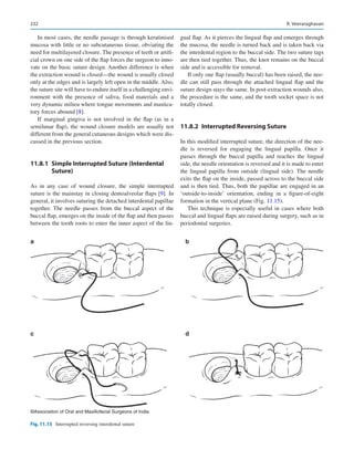 232
In most cases, the needle passage is through keratinised
mucosa with little or no subcutaneous tissue, obviating the
need for multilayered closure. The presence of teeth or artifi-
cial crown on one side of the flap forces the surgeon to inno-
vate on the basic suture design. Another difference is when
the extraction wound is closed—the wound is usually closed
only at the edges and is largely left open in the middle. Also,
the suture site will have to endure itself in a challenging envi-
ronment with the presence of saliva, food materials and a
very dynamic milieu where tongue movements and mastica-
tory forces abound [8].
If marginal gingiva is not involved in the flap (as in a
semilunar flap), the wound closure models are usually not
different from the general cutaneous designs which were dis-
cussed in the previous section.
11.8.1  
Simple Interrupted Suture (Interdental
Suture)
As in any case of wound closure, the simple interrupted
suture is the mainstay in closing dentoalveolar flaps [9]. In
general, it involves suturing the detached interdental papillae
together. The needle passes from the buccal aspect of the
buccal flap, emerges on the inside of the flap and then passes
between the tooth roots to enter the inner aspect of the lin-
gual flap. As it pierces the lingual flap and emerges through
the mucosa, the needle is turned back and is taken back via
the interdental region to the buccal side. The two suture tags
are then tied together. Thus, the knot remains on the buccal
side and is accessible for removal.
If only one flap (usually buccal) has been raised, the nee-
dle can still pass through the attached lingual flap and the
suture design stays the same. In post-extraction wounds also,
the procedure is the same, and the tooth socket space is not
totally closed.
11.8.2  
Interrupted Reversing Suture
In this modified interrupted suture, the direction of the nee-
dle is reversed for engaging the lingual papilla. Once it
passes through the buccal papilla and reaches the lingual
side, the needle orientation is reversed and it is made to enter
the lingual papilla from outside (lingual side). The needle
exits the flap on the inside, passed across to the buccal side
and is then tied. Thus, both the papillae are engaged in an
‘outside-to-inside’ orientation, ending in a figure-of-eight
formation in the vertical plane (Fig. 11.15).
This technique is especially useful in cases where both
buccal and lingual flaps are raised during surgery, such as in
periodontal surgeries.
a b
c d
©Association of Oral and Maxillofacial Surgeons of India
Fig. 11.15  Interrupted reversing interdental suture
R. Veeraraghavan
 