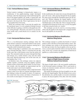 233
11.8.3  
Vertical Mattress Suture
Vertical mattress technique in dentoalveolar surgery is a
modification of the papilla-attaching simple interrupted
­
technique. After the initial passage of the needle through the
buccal and lingual papillae, the needle is turned back and
picks a small bite at the tip of the lingual papilla before pass-
ing back to the buccal side. Then it again pierces the tip of
buccal papilla before knot-tying.
While this technique helps in pressing the papilla into
the interdental space, it is not a popular technique because
of the difficulty in getting a solid bite at the papilla tip with-
out ‘cutting through’. Obviously, one needs to use an atrau-
matic needle with a small thread (4–0 or smaller) for this
purpose.
11.8.4  
Horizontal Mattress Suture
This is a two-dimensional suturing technique where the
suture thread is spread in a horizontal fashion in the tissues.
It is not very popular for general cutaneous suturing but is
especially useful in dentoalveolar surgery.
When closing flaps in edentulous areas, the needle first
passes through both flaps. Then it is reinserted into the flap
on the same side, a little distance away from the earlier exit
point. The reinserted needle now passes through both flaps
and emerges out a similar distance away from the initial
entry point. Both the thread tags, now on the same side, are
tied together (Fig. 11.16).
In dentulous areas, this technique sutures two adjacent
papillae together, eventually tying four papillae segments
around a tooth in a horizontal square fashion. To close extrac-
tion wounds, only the papillae are approximated and the
tooth socket space is not closed completely.
The advantage of this technique is that a single horizontal
mattress suture serves like two separate interrupted sutures,
thus helping to reduce the number of sutures. It compresses
the wound from four corners and helps in haemostasis. It
also results in some degree of wound eversion.
11.8.5  
Horizontal Mattress Modification:
Dental Anchor Suture
In this modification, the suture does not pass through the lin-
gual soft tissues. After passing through the buccal papilla,
the suture passes through the interdental region into the lin-
gual side. Without engaging the lingual papilla, it goes
around the tooth and comes back to the buccal side via the
interdental space on the other side. Then it engages the buc-
cal papilla before being tied. In this way, it secures the papilla
to the bone using the tooth as its ‘anchor’.
This technique can also be used in a reversing fashion,
where only the papilla on the lingual side is engaged and the
buccal side papillae are not pierced.
11.8.6  
Horizontal Mattress Modification:
Mattress Sling Suture
This technique attempts to combine the benefits of vertical
mattress suture with those of horizontal mattress suture. The
basic technique goes similar to the horizontal mattress but
the final tag re-enters the buccal papilla at the tip and tra-
verses a reverse path around the tooth to exit near the initial
entry. In this way, it ensures the engagement of both buccal
papillae in a vertical mattress fashion.
11.8.7  
Horizontal Mattress Modification:
Figure-of-Eight Suture (Cruciate
Mattress Suture/Cross Suture)
The figure-of-eight suture is the most popular modification
of the horizontal mattress technique. This is used mostly in
closure of extraction wounds, and never in the presence of
teeth at the wound site.
The needle first penetrates the buccal papilla on one side
and then the lingual papilla. Then the thread crosses across
the edentulous site, and the needle is reversed in orientation
to pierce the buccal papilla of the other side from outside
©Association of Oral and Maxillofacial Surgeons of India
Fig. 11.16 Horizontal
mattress suture (extraction
wound)
11  Wound Closure and Care in Oral and Maxillofacial Surgery
 