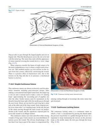 234
(buccal side) to pass through the lingual papilla and exit on
lingual side. Then the thread passes across the site to be tied
with the initial tag. The suture thus ends with the appearance
of suture material crossing the wound site in a ‘cross’ shape
(Fig. 11.17).
Many surgeons consider the figure-of-eight suture to be
the most comprehensive way to suture a single tooth extrac-
tion site. This method ensures an even tension on the tis-
sues from four corners, effectively constricting the wound.
There is a positive effect on haemostasis also, due to the
tension on the flap and due to its presence a mechanical
barrier to clot loss.
11.8.8  
Simple Continuous Suture
The continuous sutures are almost exclusively used for eden-
tulous situations including post-extraction closure. After
making a conventional interrupted suture knot, the longer tag
is not cut and is instead used to make a series of ‘running
loops’ approximating the succeeding pair of papillae one
after the other. Gentle tension must be maintained on the
thread to keep the loops tight while the needle passes through
the next tissue. Knots are not tied for each loop but is done
only at the other end of the long wound. Some surgeons pre-
fer to tie a knot after 3 or 4 running loops. In the end, the part
of the suture passing through the inner tissues are perpen-
dicular to the wound, and the superficial, exposed parts lie
across the wound in an oblique fashion.
The continuous sutures save time and effort while closing
wounds of long span. It also ensures an even distribution of
tension across the wound. The obvious disadvantage is the
fact that if one loop or part of the suture is compromised (by
untying, cutting through or loosening), the entire suture line
gets loosened.
11.8.9  
Continuous Locking Suture
The continuous locking suture is a continuous suture in
which a ‘lock’ is incorporated by passing the thread under
the previous loop before it is pulled through the tissue. It is
important to keep maintaining the tension on the previous
loops as the needle makes the next pass through the tissue
(Fig. 11.18).
©Association of Oral and Maxillofacial Surgeons of India
Fig. 11.17 Figure-of-eight
suture
©Association of Oral and Maxillofacial Surgeons of India
Fig. 11.18  Continuous locking suture (dentoalveolar)
R. Veeraraghavan
 