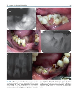 263
Fig. 13.3 (a) Intraoral periapical radiograph showing grossly carious
second molar indicated for extraction. (b) Clinical Photograph showing
pulpal pathology. (c) Clinical Photograph showing generalized peri-
odontitis. (d) Radiograph showing developing root caries following
endodontic treatment. (e) Radiograph showing fractured central inci-
sors. (f) Clinical Photograph showing root pieces. (g) Clinical
Photograph showing supernumerary teeth. (h) OPG showing impacted
mandibular canine. (i) OPG showing left mandibular third molar in
fracture line. (j) OPG showing cyst associated with impacted maxillary
canine
a b
c d
e f
13  Principles and Techniques of Exodontia
 