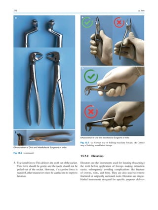 270
	5.	 Tractional forces: This delivers the tooth out of the socket.
This force should be gentle and the tooth should not be
pulled out of the socket. However, if excessive force is
required, other maneuvers must be carried out to improve
luxation.
13.7.2  Elevators
Elevators are the instruments used for luxating (loosening)
the teeth before application of forceps making extraction
easier, subsequently avoiding complications like fracture
of crowns, roots, and bone. They are also used to remove
fractured or surgically sectioned roots. Elevators are single-­
bladed instruments designed for specific purposes deliver-
e
f
©Association of Oral and Maxillofacial Surgeons of India
Fig. 13.6 (continued)
a
b
©Association of Oral and Maxillofacial Surgeons of India
Fig. 13.7 (a) Correct way of holding maxillary forceps, (b) Correct
way of holding mandibular forceps
A. Jain
 