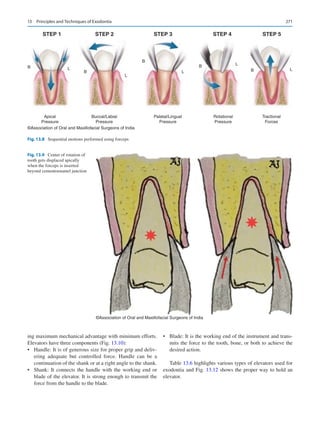 271
ing maximum mechanical advantage with minimum efforts.
Elevators have three components (Fig. 13.10):
•	 Handle: It is of generous size for proper grip and deliv-
ering adequate but controlled force. Handle can be a
continuation of the shank or at a right angle to the shank.
•	 Shank: It connects the handle with the working end or
blade of the elevator. It is strong enough to transmit the
force from the handle to the blade.
•	 Blade: It is the working end of the instrument and trans-
mits the force to the tooth, bone, or both to achieve the
desired action.
Table 13.6 highlights various types of elevators used for
exodontia and Fig. 13.12 shows the proper way to hold an
elevator.
STEP 1 STEP 2 STEP 3 STEP 4 STEP 5
B
B
B
B
B
L
L
L
L
L
Apical
Pressure
Buccal/Labial
Pressure
Palatal/Lingual
Pressure
Rotational
Pressure
Tractional
Forces
©Association of Oral and Maxillofacial Surgeons of India
Fig. 13.8  Sequential motions performed using forceps
©Association of Oral and Maxillofacial Surgeons of India
Fig. 13.9  Center of rotation of
tooth gets displaced apically
when the forceps is inserted
beyond cementoenamel junction
13  Principles and Techniques of Exodontia
 