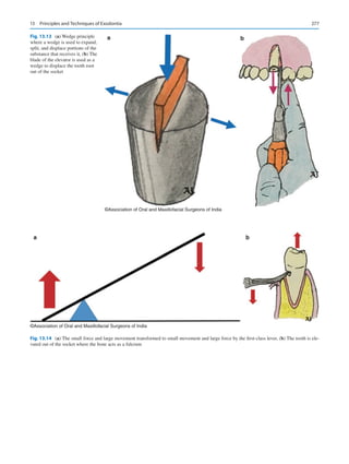 277
a b
©Association of Oral and Maxillofacial Surgeons of India
Fig. 13.13 (a) Wedge principle
where a wedge is used to expand,
split, and displace portions of the
substance that receives it, (b) The
blade of the elevator is used as a
wedge to displace the tooth root
out of the socket
a b
©Association of Oral and Maxillofacial Surgeons of India
Fig. 13.14 (a) The small force and large movement transformed to small movement and large force by the first-class lever, (b) The tooth is ele-
vated out of the socket where the bone acts as a fulcrum
13  Principles and Techniques of Exodontia
 