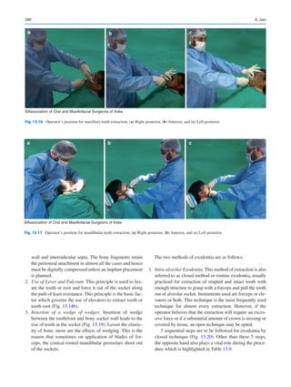 280
a b c
©Association of Oral and Maxillofacial Surgeons of India
Fig. 13.17  Operator’s position for mandibular teeth extraction, (a) Right posterior, (b) Anterior, and (c) Left posterior
a b c
©Association of Oral and Maxillofacial Surgeons of India
Fig. 13.16  Operator’s position for maxillary teeth extraction, (a) Right posterior, (b) Anterior, and (c) Left posterior
wall and interradicular septa. The bony fragments retain
the periosteal attachment in almost all the cases and hence
must be digitally compressed unless an implant placement
is planned.
	2.	 Use of Lever and Fulcrum: This principle is used to lux-
ate the tooth or root and force it out of the socket along
the path of least resistance. This principle is the basic fac-
tor which governs the use of elevators to extract tooth or
tooth root (Fig. 13.14b).
	3.	 Insertion of a wedge of wedges: Insertion of wedge
between the tooth/root and bony socket wall leads to the
rise of tooth in the socket (Fig. 13.19). Lesser the elastic-
ity of bone, more are the effects of wedging. This is the
reason that sometimes on application of blades of for-
ceps, the conical rooted mandibular premolars shoot out
of the sockets.
The two methods of exodontia are as follows:
	1.	 Intra-alveolar Exodontia: This method of extraction is also
referred to as closed method or routine exodontia, usually
practiced for extraction of erupted and intact tooth with
enough structure to grasp with a forceps and pull the tooth
out of alveolar socket. Instruments used are forceps or ele-
vators or both. This technique is the most frequently used
technique for almost every extraction. However, if the
operator believes that the extraction will require an exces-
sive force or if a substantial amount of crown is missing or
covered by tissue, an open technique may be opted.
5 sequential steps are to be followed for exodontia by
closed technique (Fig. 13.20). Other than these 5 steps,
the opposite hand also plays a vital role during the proce-
dure which is highlighted in Table 13.9.
A. Jain
 