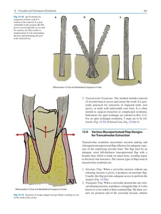 281
	2.	 Transalveolar Exodontia: This method includes removal
of alveolar bone to access and extract the tooth. It is gen-
erally practiced for extraction of impacted teeth, root
pieces, or teeth with unfavorable root form. It is often
termed as surgical extraction or complicated exodontia.
Indications for open technique are enlisted in Box 13.2.
For an open technique exodontia, 5 steps are to be fol-
lowed: (Fig. 13.23) (Clinical Case, Fig. 13.24a–f).
13.9	 
Various Mucoperiosteal Flap Designs
for Transalveolar Extraction
Transalveolar exodontia necessitates incision making and
subsequent mucoperiosteal flap reflection for adequate expo-
sure of the underlying alveolar bone. The flap must be an
adequate sized full-thickness mucoperiosteal flap with a
broader base which is made on intact bone, avoiding injury
to the local vital structures. The various types of flaps used in
transalveolar exodontia are:
	1.	 Envelope Flap: When a crevicular incision without any
releasing incision is given, it produces an envelope flap.
Usually, this flap provides adequate access to perform the
surgery (Fig. 13.25a).
	2.	 Triangular Flap: When a crevicular incision has one verti-
cal releasing incision, it produces a triangular flap. It is also
known as a two-sided or three-cornered flap. The three cor-
ners are posterior end of the crevicular incision, inferior
a b c
©Association of Oral and Maxillofacial Surgeons of India
Fig. 13.18 (a) Exodontia by
expansion of bony socket is
similar to the removal of a post
embedded in the ground, (b) The
post is moved laterally in a to and
fro motion, (c) This results in
displacement of soil surrounding
the post and permitting the post
to be removed out
©Association of Oral and Maxillofacial Surgeons of India
Fig. 13.19  Insertion of wedge-shaped forceps blades resulting in rise
of the tooth in the socket
13  Principles and Techniques of Exodontia
 