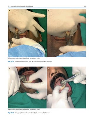 283
a b
©Association of Oral and Maxillofacial Surgeons of India
Fig. 13.21  Pinch grasp for maxillary teeth (a) Right posterior, (b) Left posterior
a b
©Association of Oral and Maxillofacial Surgeons of India
Fig. 13.22  Sling grasp for mandibular teeth (a) Right posterior, (b) Anterior
13  Principles and Techniques of Exodontia
 