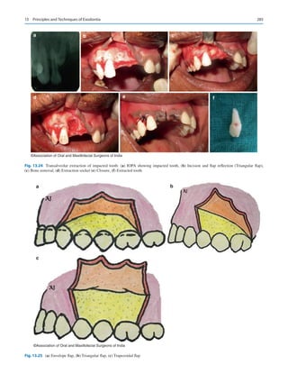 285
a b c
d e f
©Association of Oral and Maxillofacial Surgeons of India
Fig. 13.24  Transalveolar extraction of impacted tooth: (a) IOPA showing impacted tooth, (b) Incision and flap reflection (Triangular flap),
(c) Bone removal, (d) Extraction socket (e) Closure, (f) Extracted tooth
a b
c
©Association of Oral and Maxillofacial Surgeons of India
Fig. 13.25 (a) Envelope flap, (b) Triangular flap, (c) Trapezoidal flap
13  Principles and Techniques of Exodontia
 