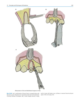 287
a b
c
©Association of Oral and Maxillofacial Surgeons of India
Fig. 13.26 (a) A small portion of buccal bone is grasped along with
the root in cases when the root is fractured at the level of alveolar bone
(Alveolar Purchase Technique), (b) A small straight elevator is being
used to luxate the broken root, (c) Bone is removed from the buccal
aspect of the root using a bur
13  Principles and Techniques of Exodontia
 
