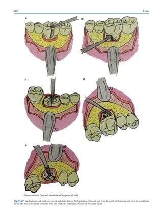 288
a b
c d
e
©Association of Oral and Maxillofacial Surgeons of India
Fig. 13.27 (a) Sectioning of tooth into mesial and distal halves, (b) Separation of mesial root from the tooth, (c) Separation of roots of mandibular
molar, (d) Buccal roots are sectioned from the tooth, (e) Separation of roots of maxillary molar
A. Jain
 