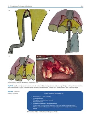 291
a b
c d
©Association of Oral and Maxillofacial Surgeons of India
Fig. 13.28 (a) The root tip elevator is inserted into the periodontal ligament space to elevate the root tip, (b) Open technique for removal of frac-
tured root fragment, (c) Open Window technique for removal of fractured root fragment, (d) Clinical picture of open window technique
Criteria for leaving root piece in situ
• If it is small (2 – 3mm in length)
• If it is deep seated
• If it requires excessive bone removal
• If it is not infected
• If there is no presence of periapical infection
• If it is in close proximity to vital structures which may be injured during retrieval
• If during exploration there are chances of its displacement to adjacent anatomical
spaces.
©Association of Oral and Maxillofacial Surgeons of India
Box 13.6  Criteria for
retaining root piece
13  Principles and Techniques of Exodontia
 